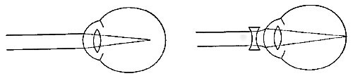 FIG. 81.&mdash;The nearsighted eye. The defect is remedied
by concave glasses.