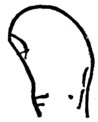 Fig. 1.&mdash;THE CLUBBED THUMB.