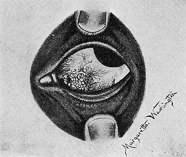 41. (a) Nodular conjunctivitis in the eye of a child.
De Schweinitz and Shumway.