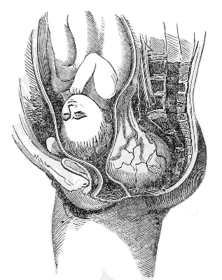 Case of
Tumor